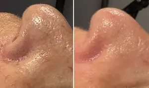 Hydrafacial skin treatment at Cosmetic Beauty UK in London