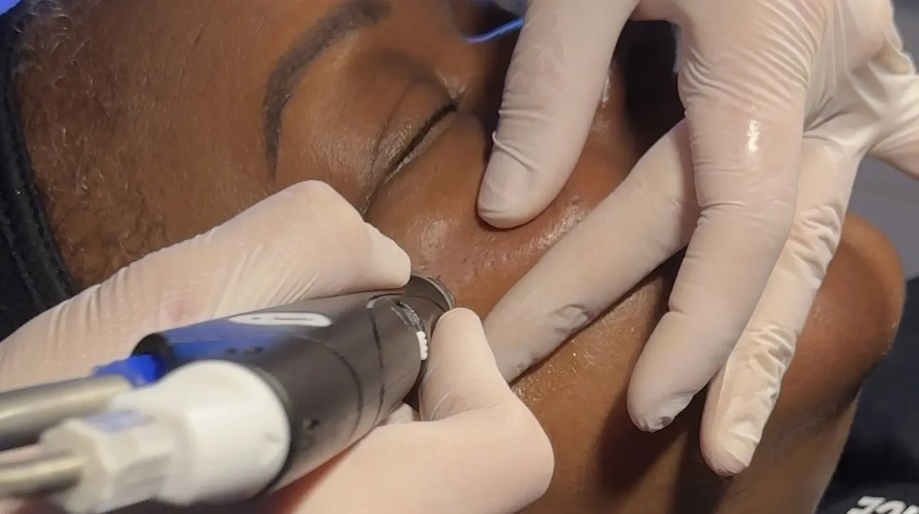 Hydrafacial Platinum application
