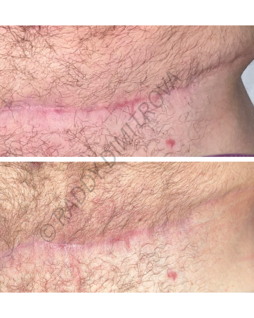 microneedling a tummy tuck scar before and after